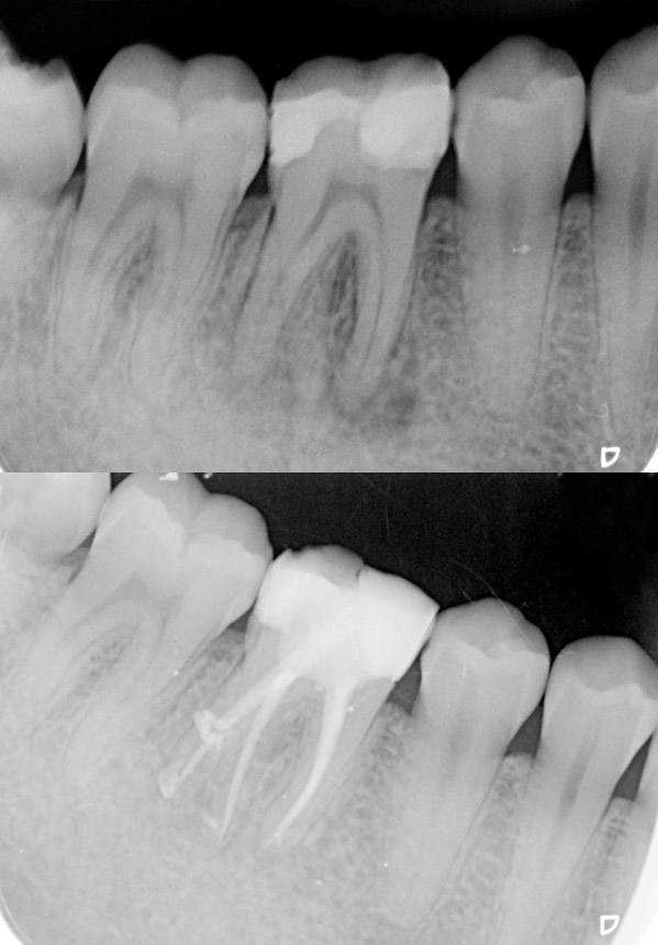 Odontología-endodoncia-ClinicaMontesPamplona