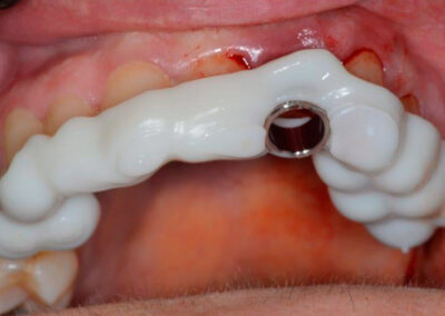 Clinica Dental Montes - Implantología oral avanzada