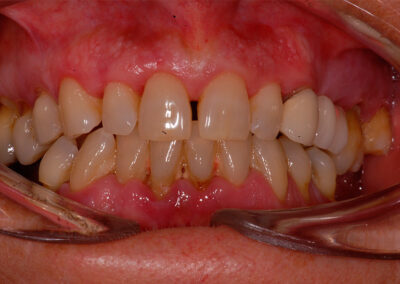 Clinica dental Montes - Implantología oral avanzada- Caso 2