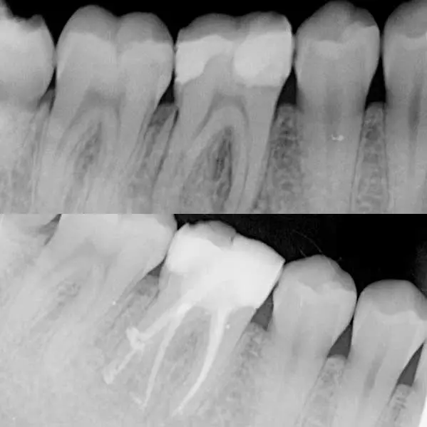 endodoncia