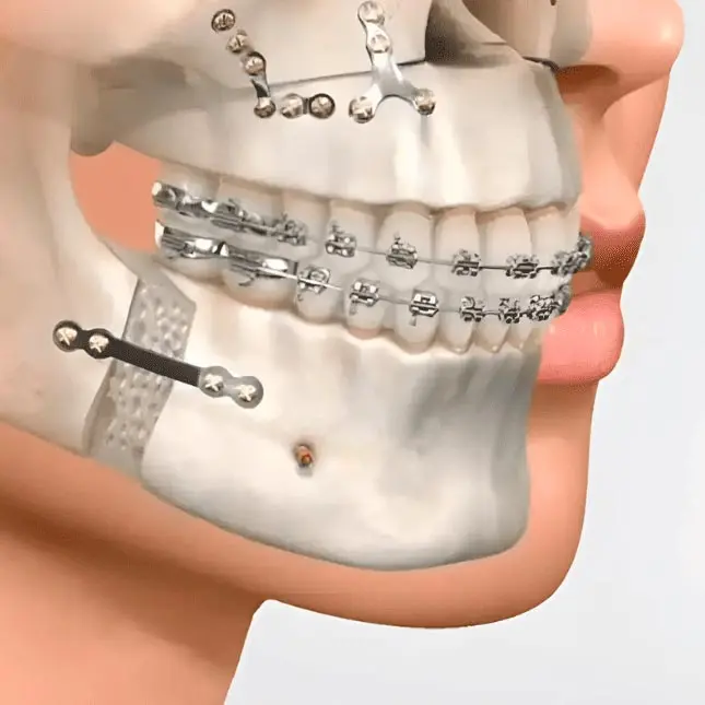 Cirugía ortognática – Corrección ósea facial y funcionalidad