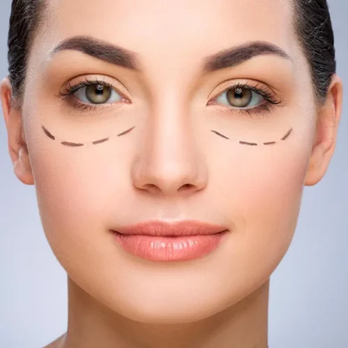 Blefaroplastia – Cirugía de párpados en Pamplona