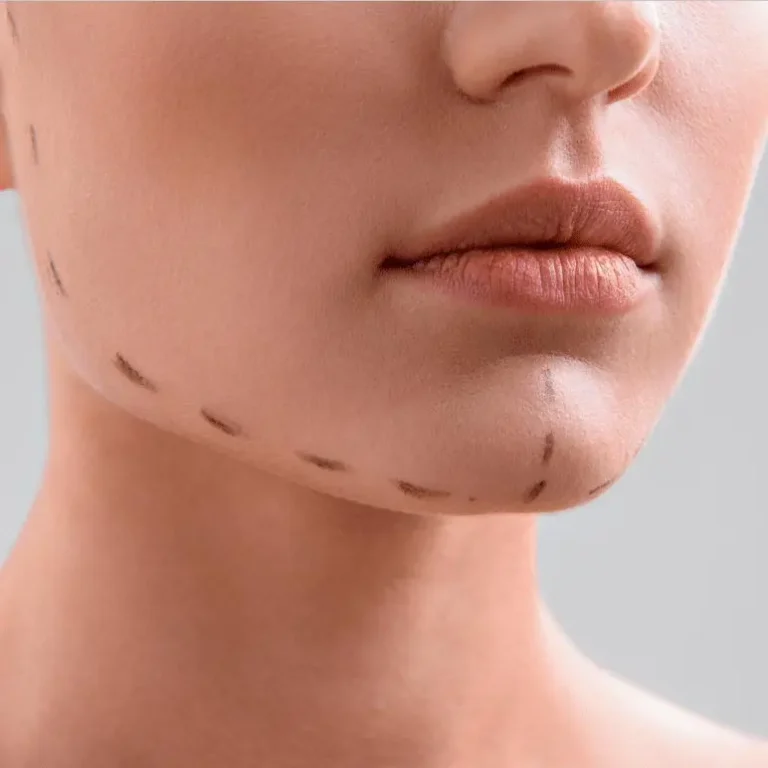 Mentoplastia